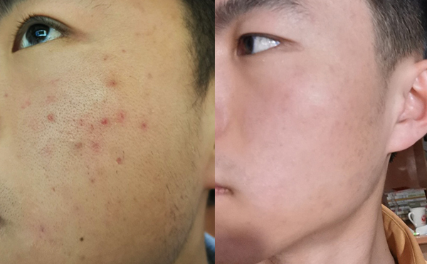 白瓷娃娃每次治療間隔多久？
