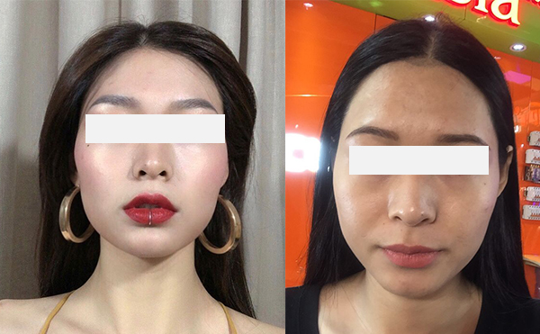激光脫發(fā)際線效果怎么樣？
