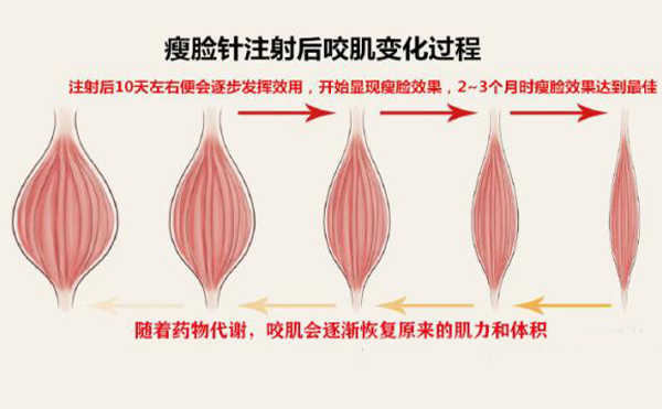 打瘦臉針打多少單位？