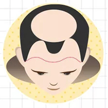 六級脫發(fā)