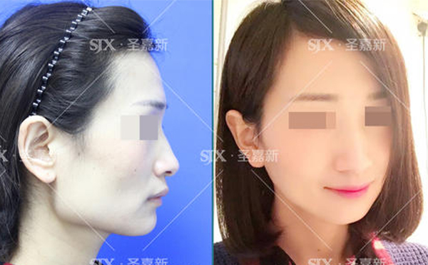 下頜角整形后皮膚是否會松弛？