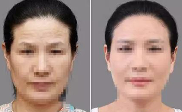 激光除皺有什么優(yōu)勢(shì)？