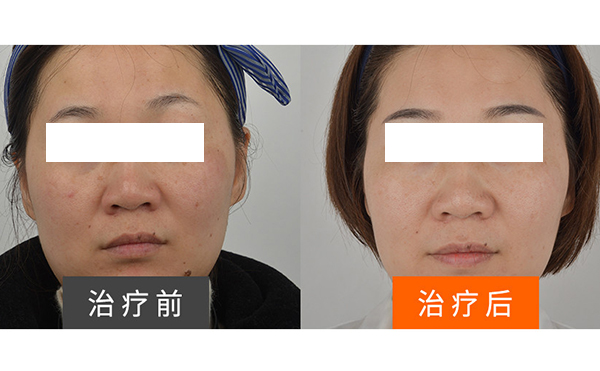彩光嫩膚安全不安全？