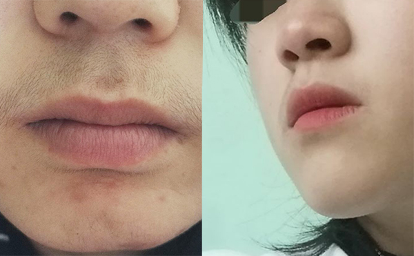 面部激光脫毛有什么優(yōu)勢(shì)？