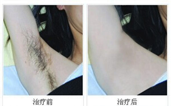 冰點(diǎn)脫腋毛安全嗎？