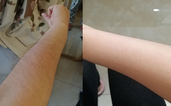 光子手臂脫毛幾次能脫完？