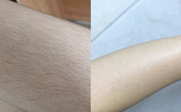 激光手臂脫毛安全嗎？