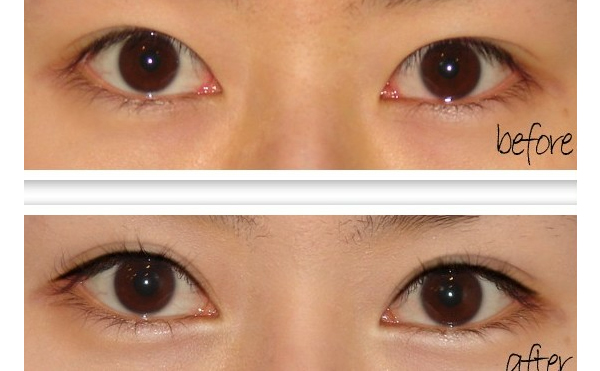 開眼角手術有什么原則？