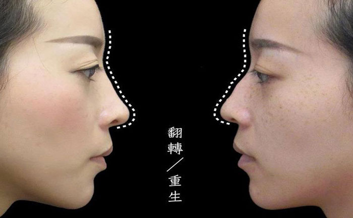 駝峰鼻矯正多少錢？駝峰鼻矯正有危險嗎？
