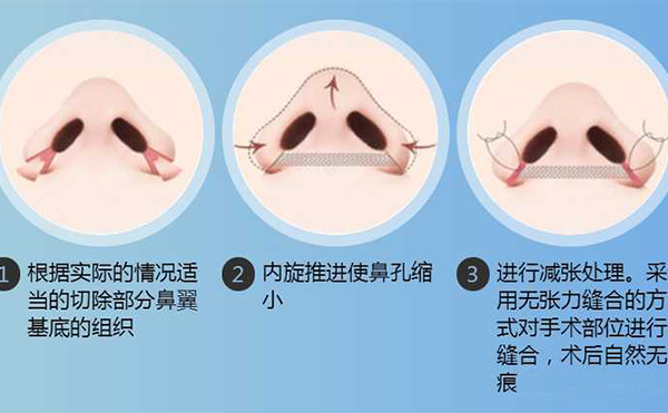 鼻翼縮小手術(shù)有用嗎？