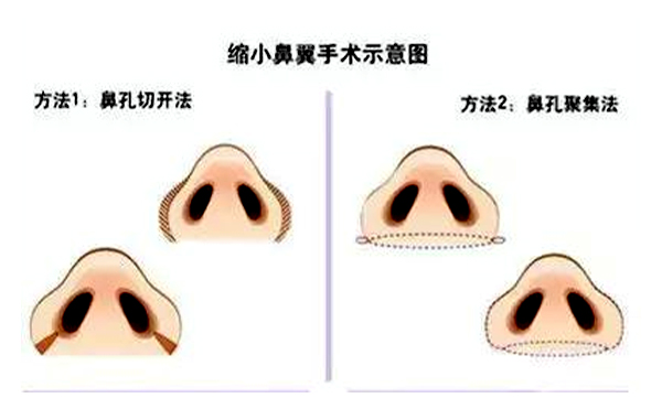  鼻翼縮小有后遺癥嗎？會不會反彈