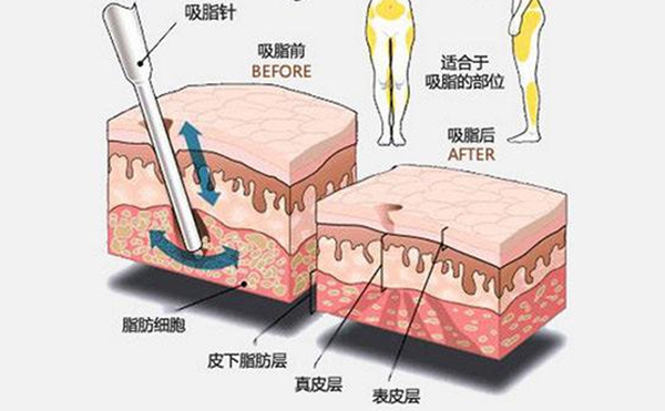 大腿吸脂有什么優(yōu)點？