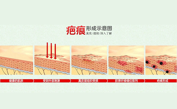 疤痕體質(zhì)割雙眼皮怎么樣?如何自測(cè)疤痕體質(zhì)?