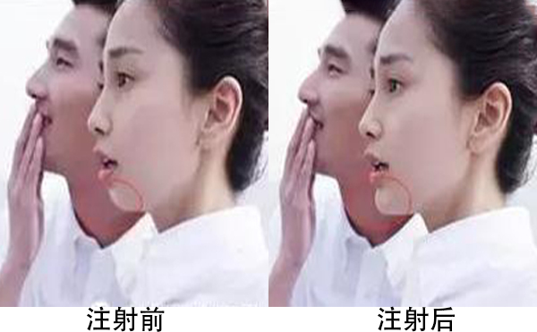 膨體隆下巴容易引發(fā)感染嗎?恢復后手術(shù)切口會不會被人被看出來?
