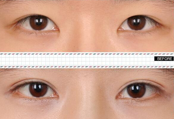 做雙眼皮價(jià)格是多少？哪種眼睛適合做雙眼皮呢?