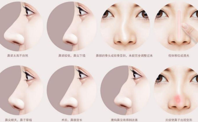 鼻尖整形大概多少錢(qián)？
