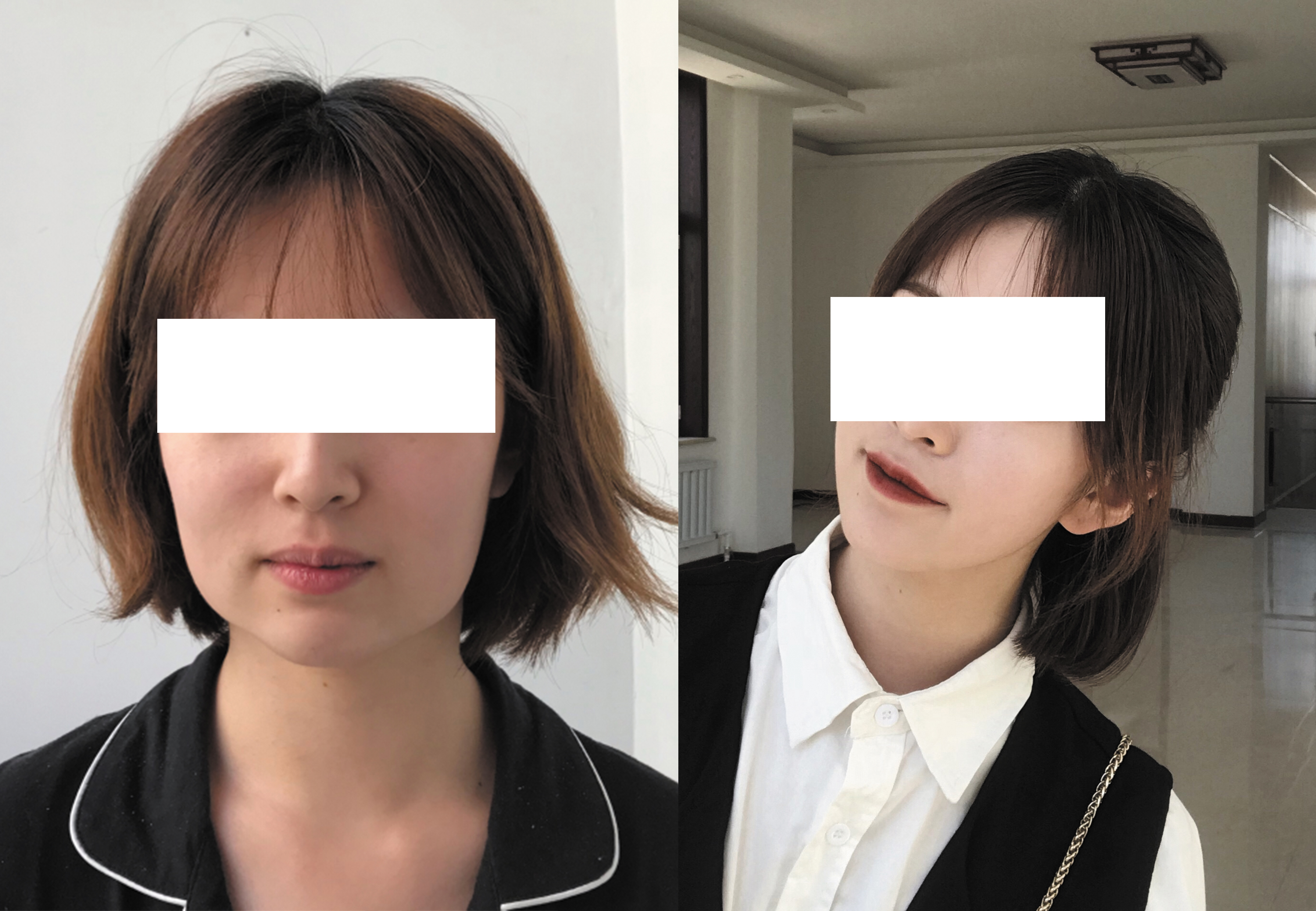 合肥藝星周海林醫(yī)生手術(shù)效果圖2