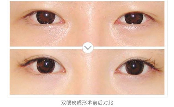 全切雙眼皮會(huì)越來越窄嗎?全切雙眼皮多久能恢復(fù)正常?