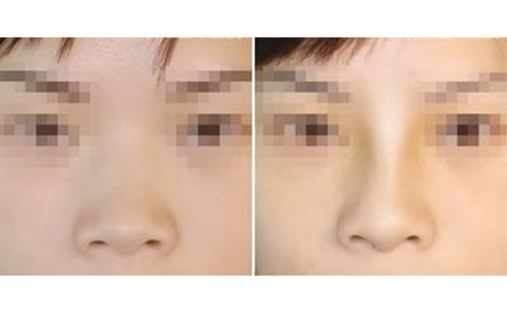 做隆鼻手術(shù)會留疤嗎？