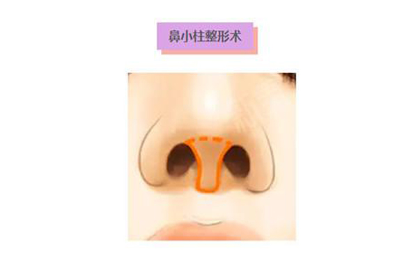 鼻小柱延長(zhǎng)術(shù)是什么？鼻小柱延長(zhǎng)手術(shù)有什么優(yōu)點(diǎn)