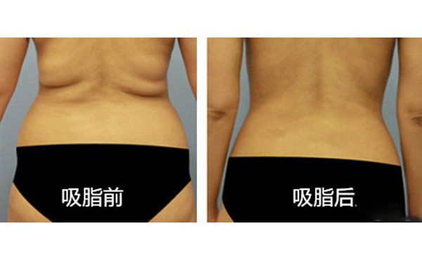 腹部吸脂需要多久恢復(fù)？