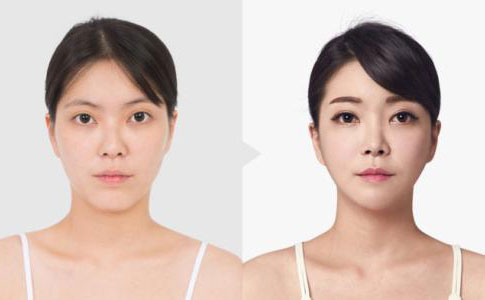 韓式埋線雙眼皮多久恢復(fù)自然？