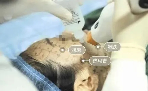 牙齒矯正期間是不能做熱瑪吉嗎？
