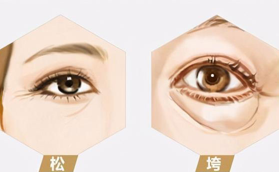無痛去眼袋價(jià)格多少錢？