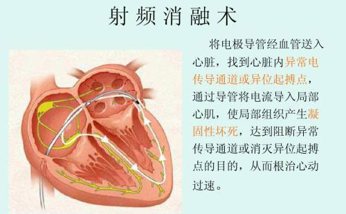 射頻祛眼袋效果怎么樣？