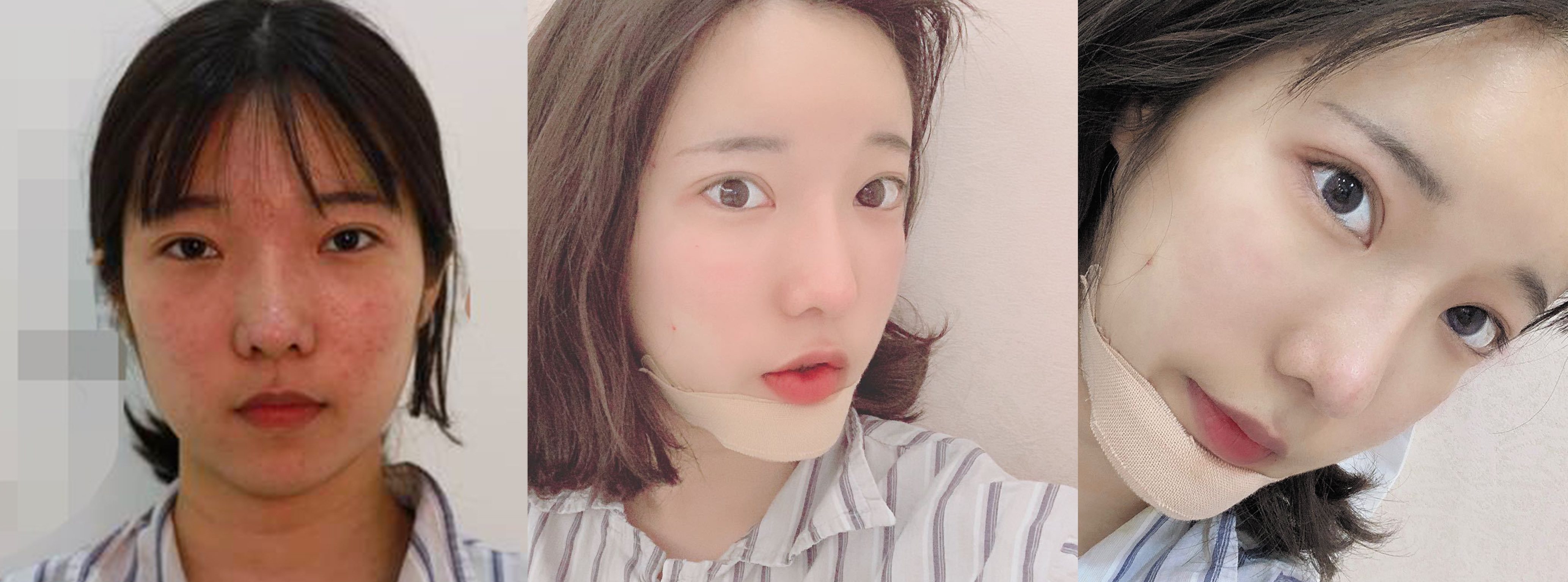 杭州時光自體脂肪填充效果圖1