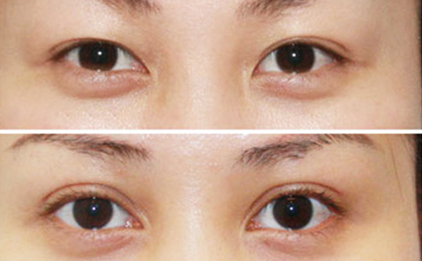 內(nèi)雙做雙眼皮是什么價格？效果怎么樣？