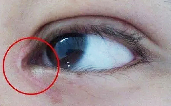 內(nèi)眼角修復(fù)難不難？哪些情況需要修復(fù)?