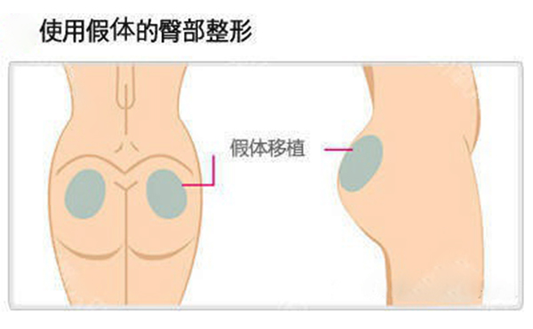 假體豐臀多少錢？假體豐臀效果是永久的嗎？