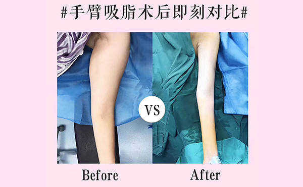 手臂吸脂會(huì)反彈嗎？