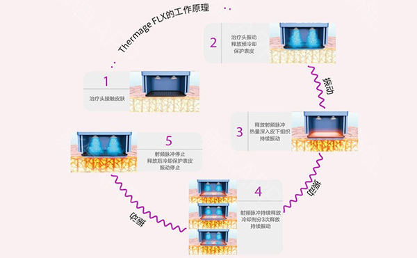 電波拉皮怎么去除魚尾紋？