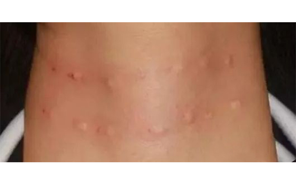 嗨體注射