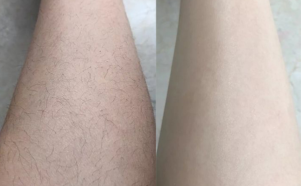 冰點(diǎn)脫腿毛效果怎么樣？