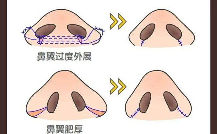 鼻頭肥大怎么改善？鼻頭肥大矯正術(shù)多少錢？