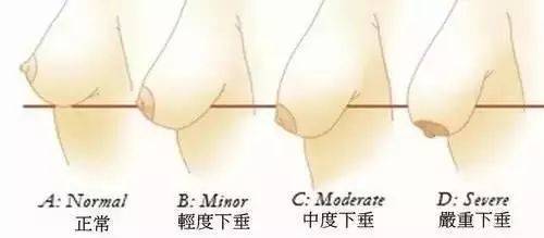 產(chǎn)后胸部下垂怎么辦？