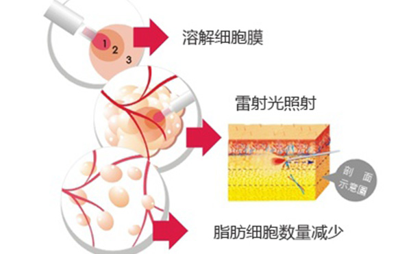 吸脂和溶脂有什么區(qū)別?哪個效果好?