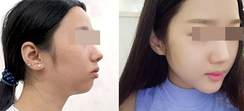 北京潤(rùn)美玉之光醫(yī)療美容墊下巴