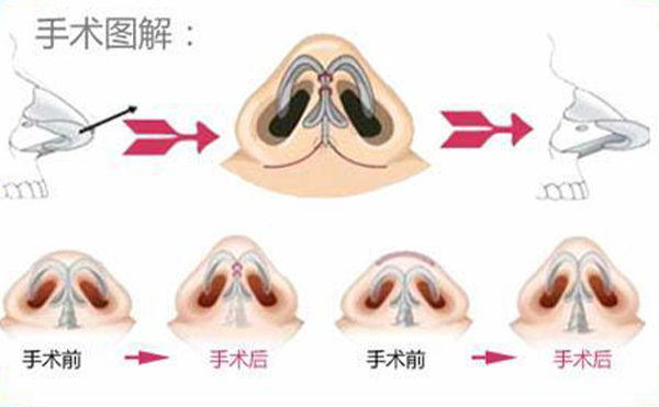 鼻翼縮小手術(shù)過(guò)程