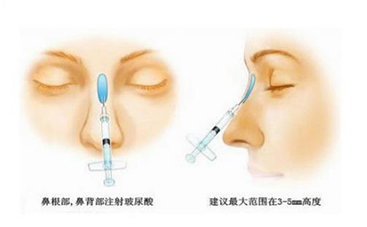 注射隆鼻的優(yōu)點(diǎn)