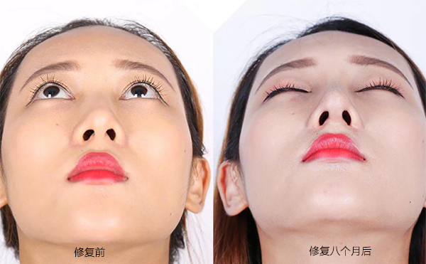 隆鼻手術(shù)失敗怎么辦？修復(fù)費(fèi)用要多少？