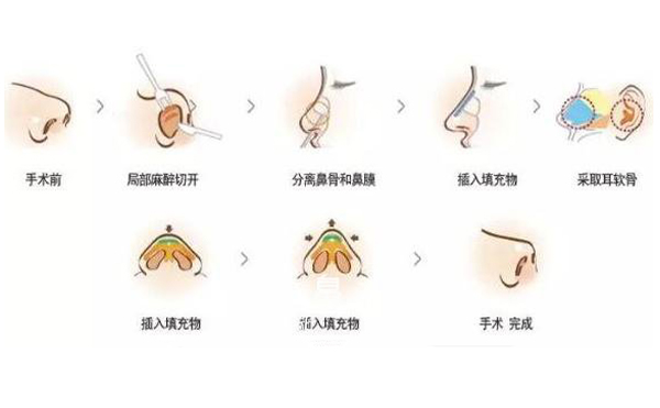 耳軟骨隆鼻效果怎么樣？要多少錢？