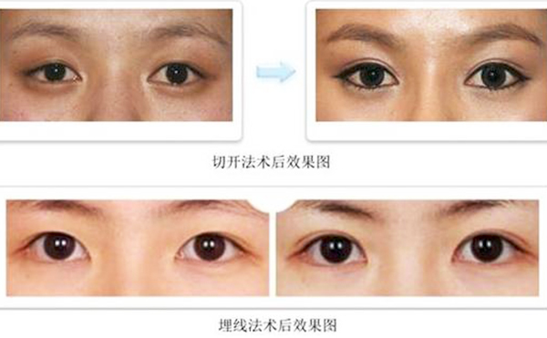雙眼皮埋線和切開哪個比較好?疼痛程度有什么不同？