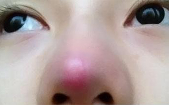 術(shù)后鼻頭發(fā)紅是隆鼻手術(shù)失敗了嗎？該怎么處理？