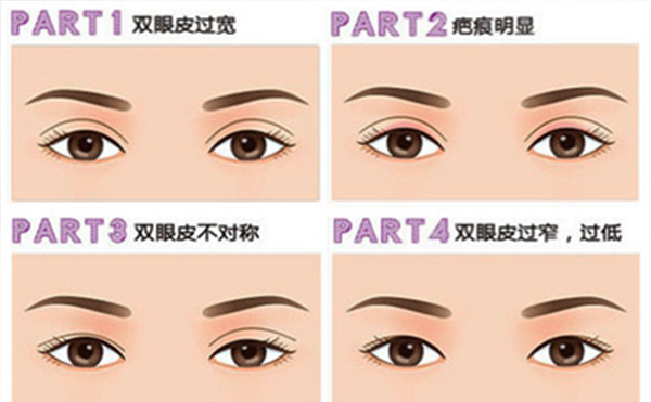雙眼皮失敗有哪些明顯表現(xiàn)？修復(fù)成功率大嗎？