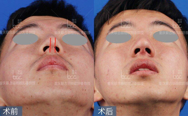歪鼻修復(fù)術(shù)要多少錢？