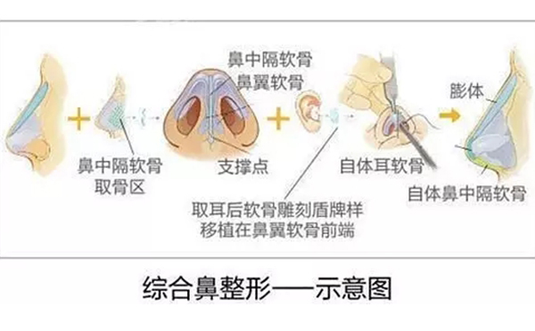 鼻綜合整形的效果怎么樣？鼻綜合手術(shù)安全嗎？